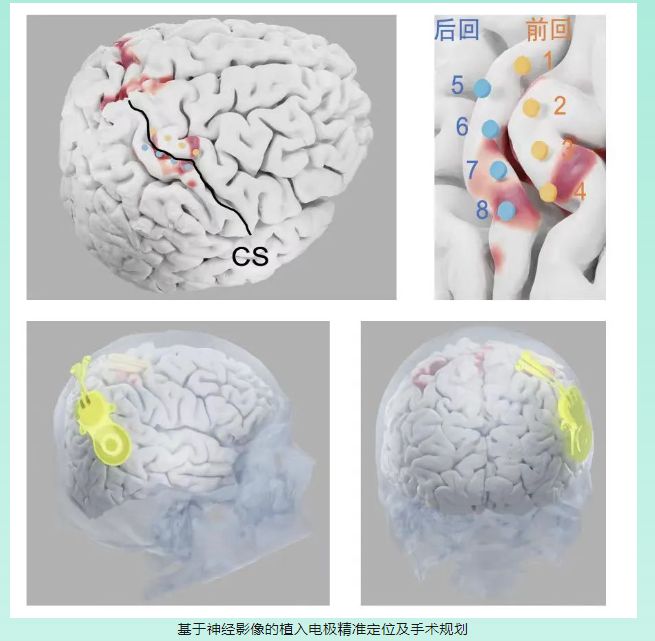 Neuralink革命性进展:马斯克确认2025年将为20至30名患者提供脑机接口植入_Neuralink革命性进展:马斯克确认2025年将为20至30名患者提供脑机接口植入_Neuralink革命性进展:马斯克确认2025年将为20至30名患者提供脑机接口植入