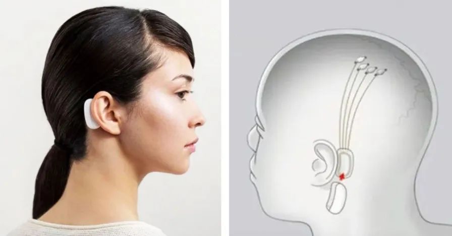 马斯克发明植入脑机接口_脑机接口的未来:马斯克确认2025年Neuralink将为20至30名患者实施植入_马斯克脑机接口治疗中风后遗症